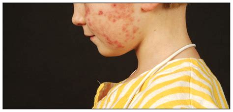 Leukemia cutis: an unusual rash in a child | CMAJ