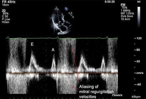 Spectral Doppler