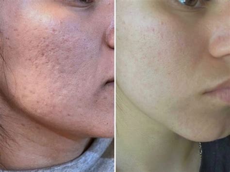 Getting Rid of Acne Scars With Microneedling | Raw Beauty Medical Spa