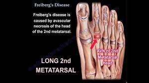 Suffering from Freiberg's Disease? Put Your Feet in Our Hands