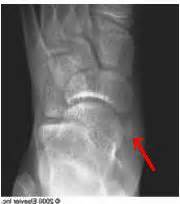 Accessory Navicular - Pediatrics - Orthobullets