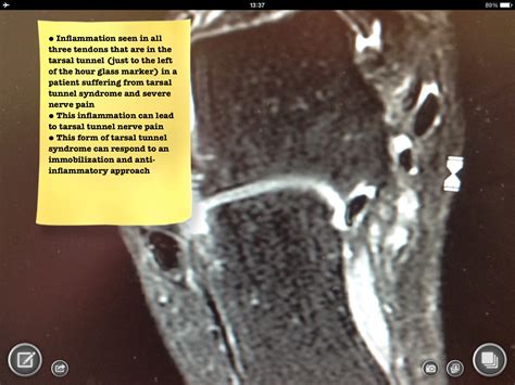 Foot and Ankle Problems By Dr. Richard Blake: Tarsal Tunnel Syndrome: MRI crucial to look for ...