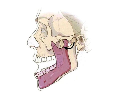 How to Reduce a TMJ Dislocation? - OdontoVida