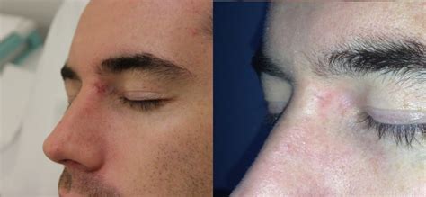 Cyst Removal Prices, Costs | Skin Surgery Laser Clinic