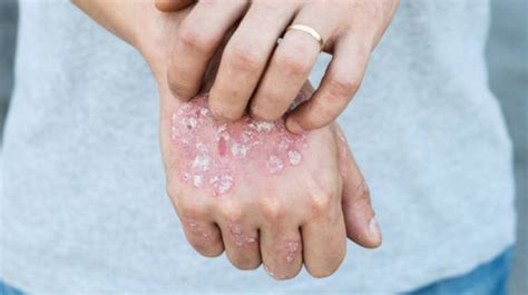 Plaque Psoriasis Symptoms, Causes, And Treatments