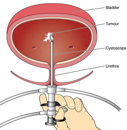 Transurethral Resection Of The Bladder