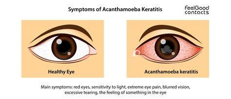 What is Acanthamoeba Keratitis? | Feel Good Contacts