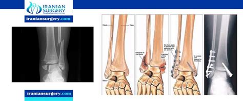 Bimalleolar and Trimalleolar Ankle Fractures | Iranian Surgery