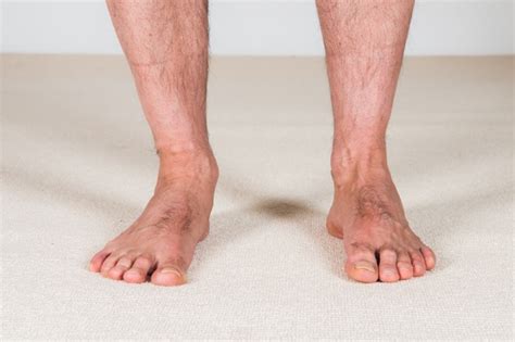 What is overpronation (flat foot / dropped arch) and what are its causes?