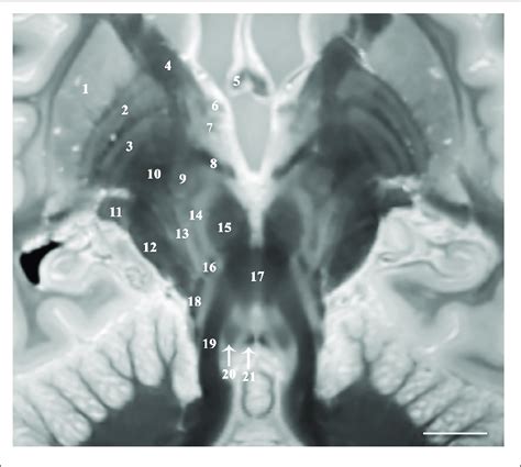 | Image parallel to the superior cerebellar peduncles and their... | Download Scientific Diagram