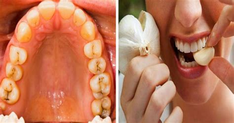 Reverse Tooth Decay and Heal Cavities With These Powerful Home Remedies ...