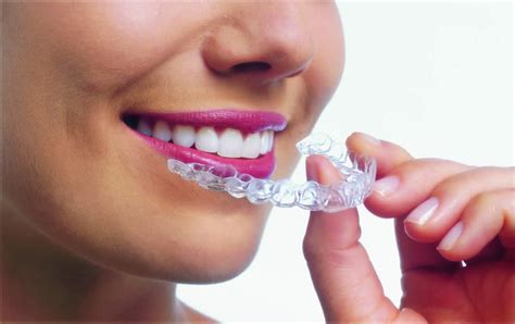 Types of Orthodontic Treatment - Burckhard Orthodontics