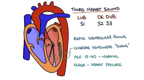 Murmurs – Zero To Finals | Aortic stenosis, Heart sounds, Marfan syndrome