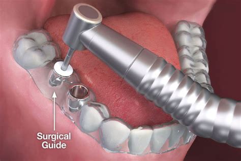 3D guided implant surgery in Winchester | Dentist 22601| Smiles of Virginia