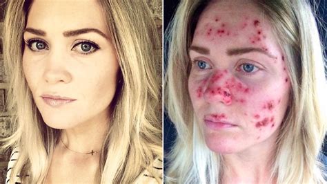 Woman's Skin Cancer Selfies Go Viral — and Inspire Skin Checks | Allure