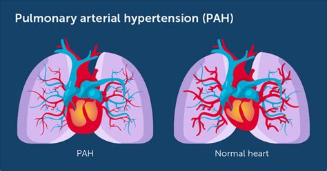 Pulmonary Artery Hypertension