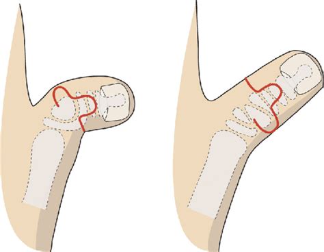 Schematic of surgical treatment for clinodactyly using bilobed flap. It ...