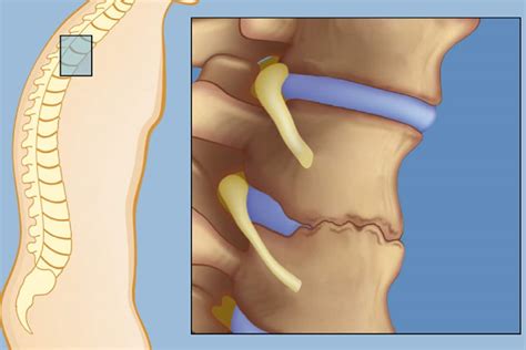 What is an Spondylitis? Causes & Treatment | Spine & Orthopedic Center