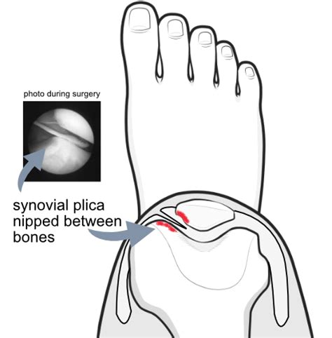 Plica surgery | KNEEguru