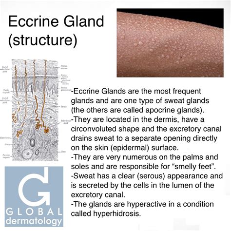 Global Dermatology » Eccrine Gland (structure) (Instagram)