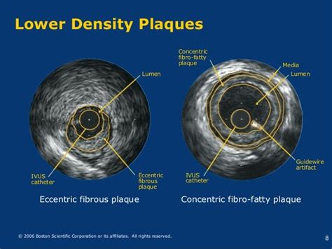 IVUS Image Interpretation and Analysis