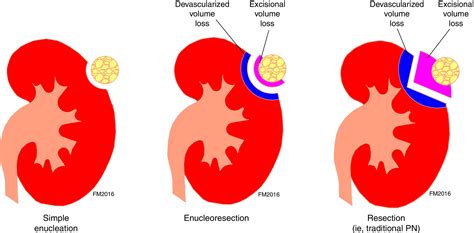 Renal Preservation and Partial Nephrectomy: Patient and Surgical Factors - European Urology Focus