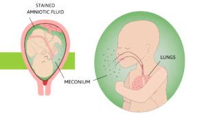 Today's Tip: Light Meconium-stained Fluid – Intellis