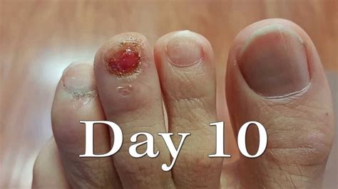 Toenail Injury Time-Lapse Regrowth - YouTube