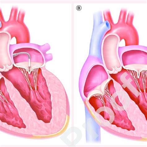 Procedural images of a MitraClip ® implantation. (A) 2D transesophageal ...