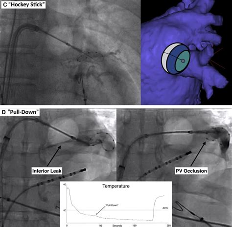 Cryoablation for atrial fibrillation - Heart Rhythm O2