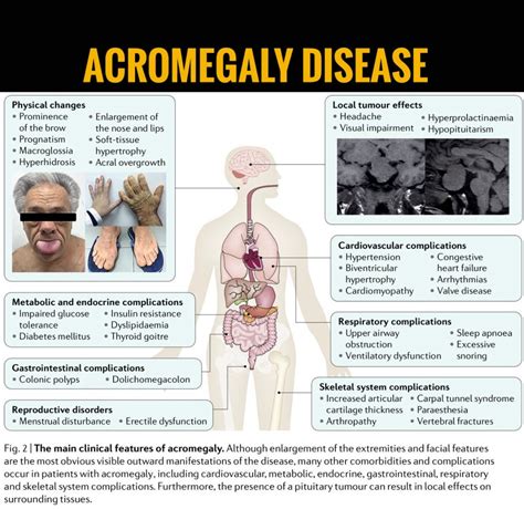 Understanding Acromegaly: Symptoms, Diagnosis, and Treatments Explained ...