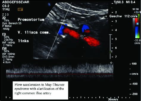 May-Thurner syndrome colour Doppler sonography of presented patient ...