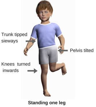 Pigeon toes, in-toeing gait, femoral anteversion and tibial torsion | Physical therapy exercises ...