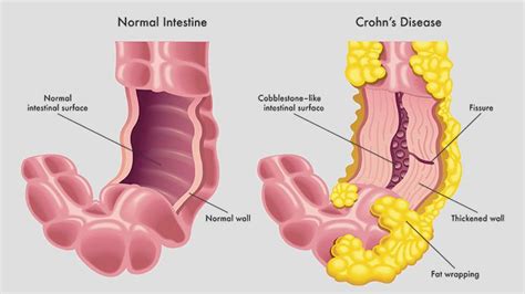 Crohn's Disease and Creeping Fat | Everyday Health Crohns Symptoms ...