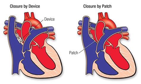 Atrial Septal Defect (ASD) | American Heart Association