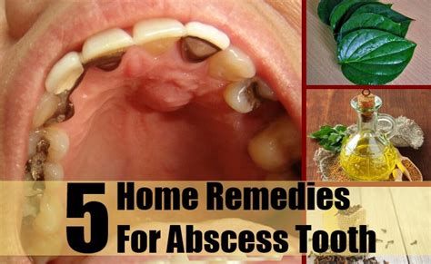 5 Home Remedies For Abscess Tooth – Natural Home Remedies & Supplements