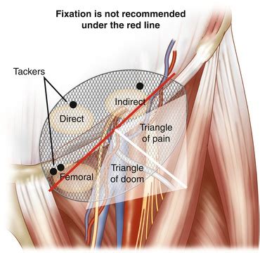 Prostheses Fixation During Laparoscopic Inguinal Hernia Repair | Abdominal Key