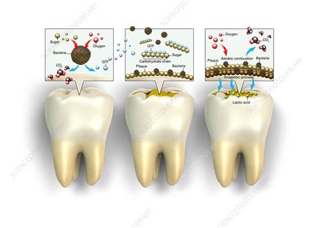 Formation of plaque on teeth, illustration - Stock Image - C047/7641 ...