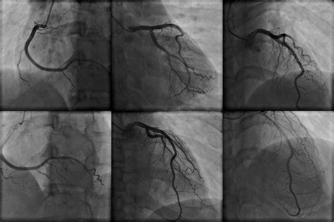 Detecting Ischemia in Myocardial Bridging With CT Angiography-Derived FFR - The Cardiology Advisor