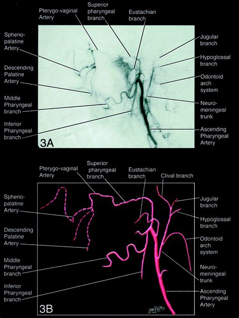 The Ascending Pharyngeal Artery: Branches, Anastomoses, and Clinical Significance | American ...