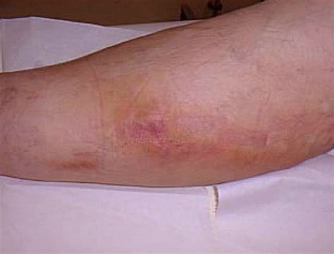 Thrombophlebitis Causes, Symptoms, Diagnosis and Treatment - Natural Health News