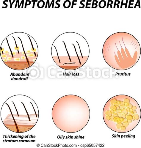 Symptoms of seborrhea. seborrhea skin and hair. dandruff, seborrheic dermatitis. baldness, hair ...