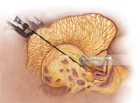 Surgical considerations with morbid obesity | Illustration by Alex Webber