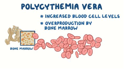 Polycythemia vera (NORD): Video, Anatomy & Definition | Osmosis