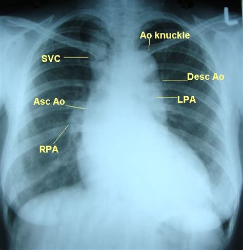 Dilated aorta with unfolding of arch on X-ray chest PA view – All About ...