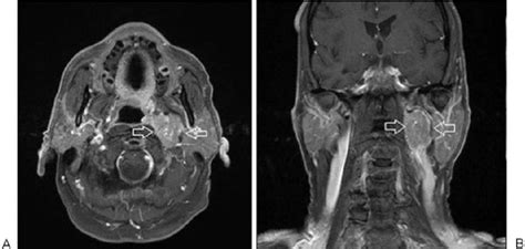 T1-weighted MRI in December 2005 demonstrates a left carotid sheath ...