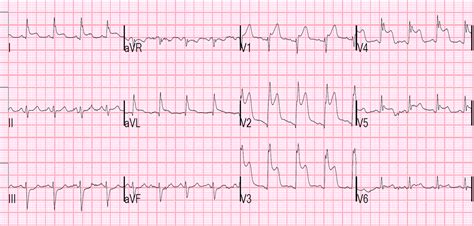 Dr. Smith's ECG Blog: Is the LAD really completely occluded when there are de Winter's waves?