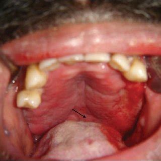 Erythematous, edematous, inflamed gingival and palatal mucosa extending... | Download Scientific ...