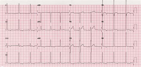 Wellens Syndrome Litfl