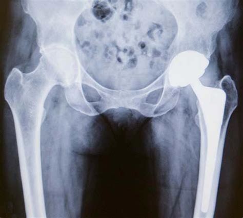 Total hip replacement recovery timetable - dasedrum